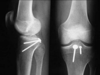 Les Fractures du genou