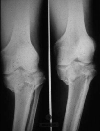 Les Fractures du genou